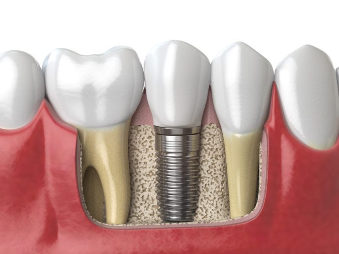 Affordable dental Implants in Fayetteville Arkansas