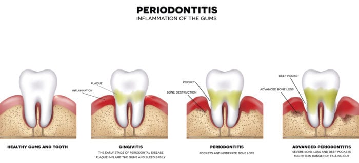 Periodontal Therapy in Fayetteville AR