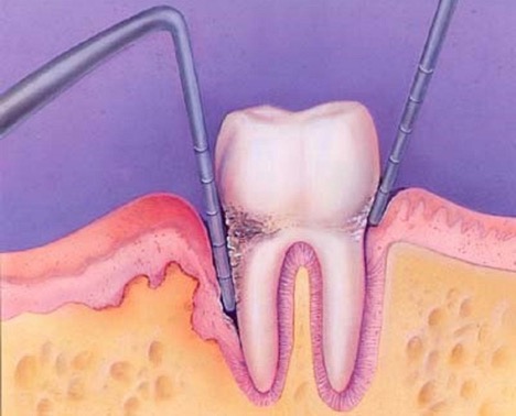 Through of tooth gum poking Bone fragments