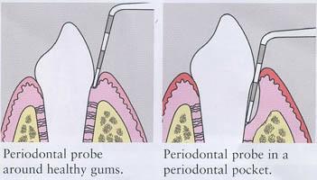 gum disease chart