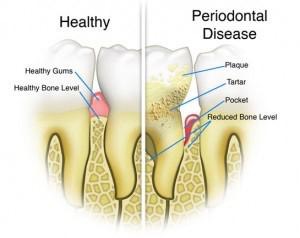 chart of health gums versus periodontal disease