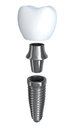 Advantages of Dental Implants Hoffman Estates, IL