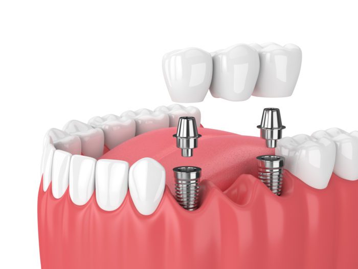Multiple Dental Implants Fayetteville, AR