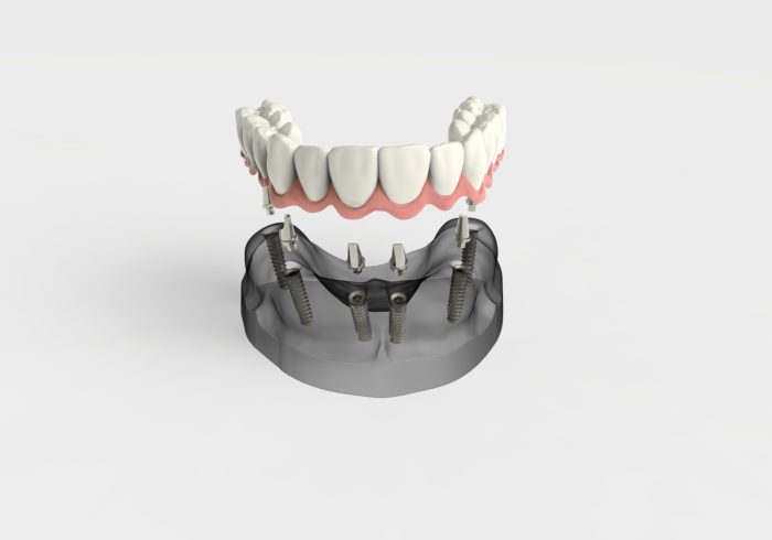 Denture Implants Fayetteville, AR