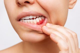 Why Do I Have Bleeding Gums?