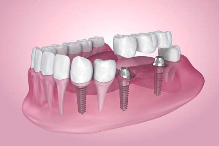 DENTAL BRIDGES in Fayetteville AR can help restore missing teeth