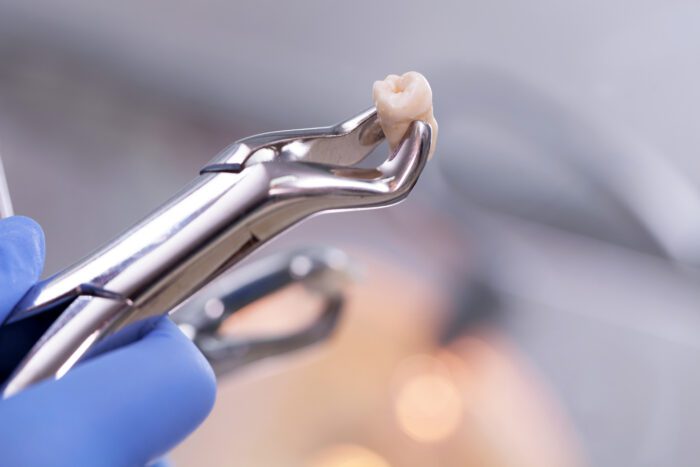 A TOOTH EXTRACTION in Fayetteville AR is nothing to fear once you know what to expect.