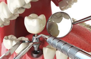 DENTAL IMPLANTS in FAYETTEVILLE AR offer many benefits to improve your bite and restore your smile.