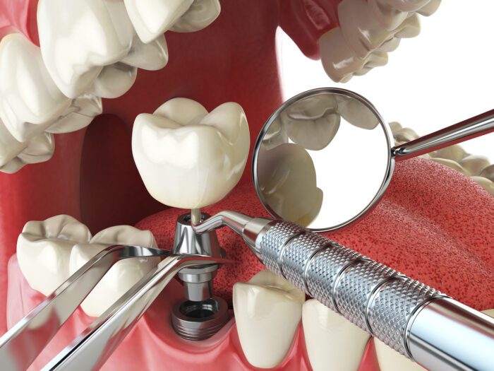 DENTAL IMPLANTS in FAYETTEVILLE AR offer many benefits to improve your bite and restore your smile.