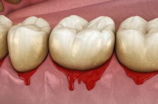 Bleeding Gums in Fayetteville, AR, could be a warning sign of gum disease