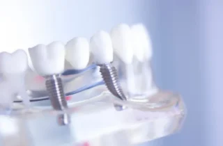 Why Invest in an Implant-Supported Dental Bridge in Fayetteville, AR