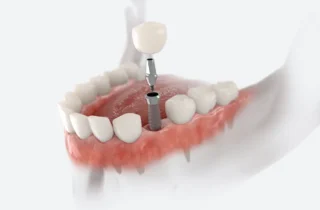 Dental Implants vs. Bridges: Which Is Right for You? in Fayetteville, AR