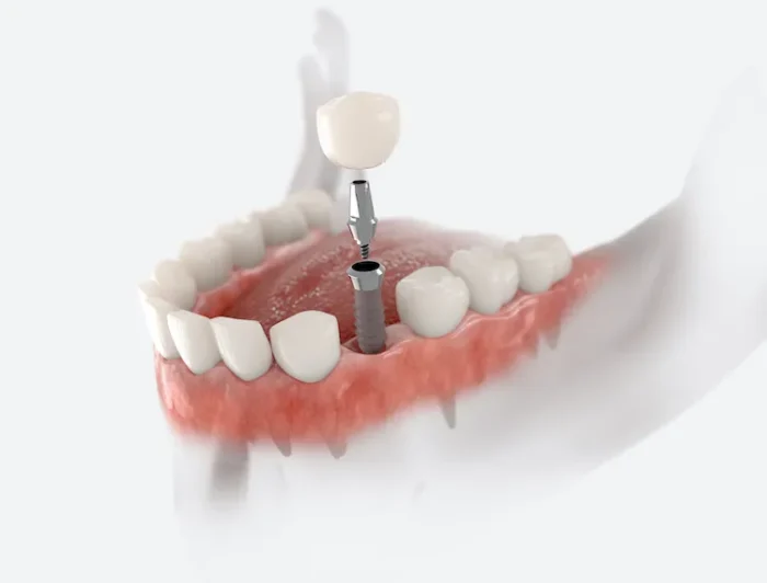 Dental Implants vs. Bridges: Which Is Right for You? in Fayetteville, AR